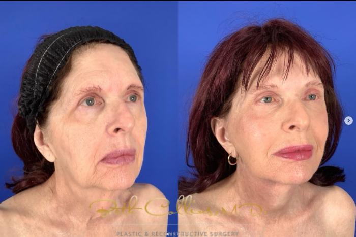 Before & After Facelift Case 265 Right Oblique View in Guilford, CT