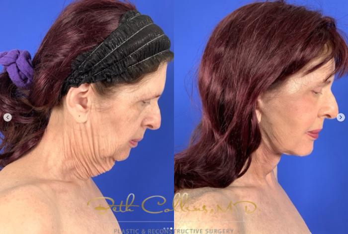 Before & After Facelift Case 265 Right Side - Head Bent View in Guilford, CT