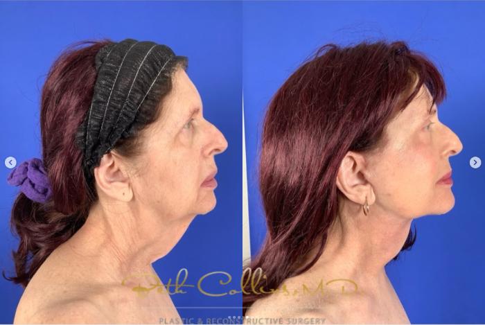 Before & After Neck Liposuction Case 265 Right Side View in Guilford, CT