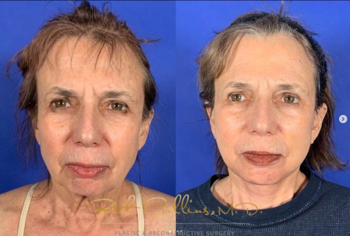 Before & After Facelift Case 266 Front - 2 Weeks After Surgery View in Guilford, CT