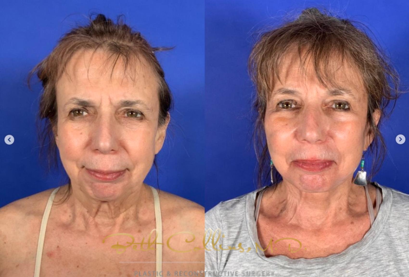 Before & After Neck Lift Case 266 Front View in Guilford, CT