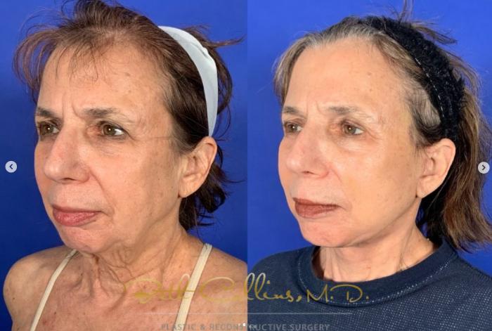 Before & After Neck Lift Case 266 Left Oblique - 2 Weeks After Surgery View in Guilford, CT