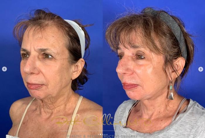 Before & After Facelift Case 266 Left Oblique View in Guilford, CT