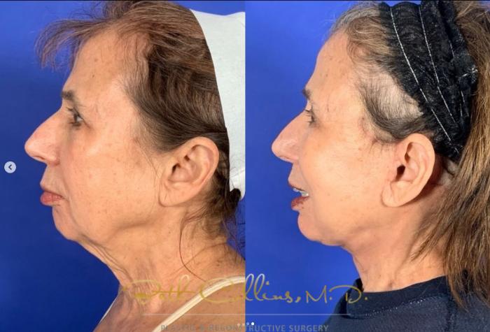 Before & After Facelift Case 266 Left Side - 2 Weeks After Surgery View in Guilford, CT