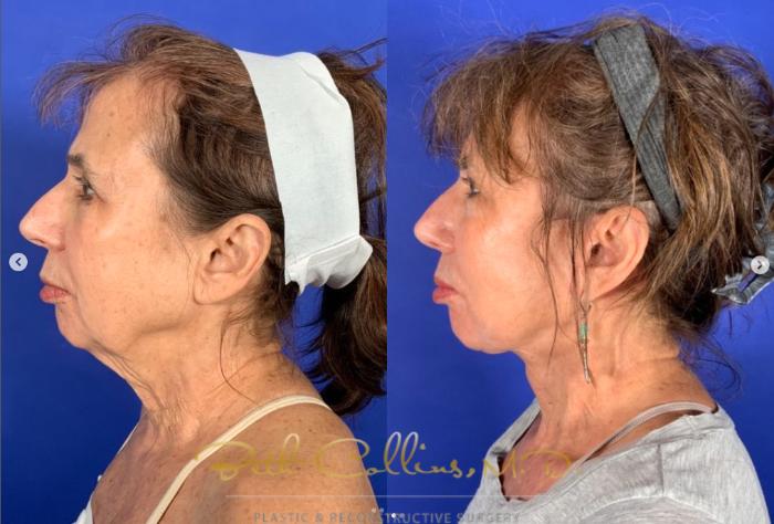 Before & After Neck Lift Case 266 Left Side View in Guilford, CT