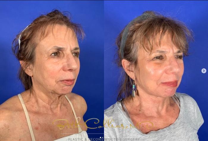 Before & After Facelift Case 266 Right Oblique View in Guilford, CT