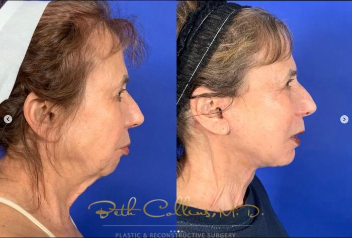 Before & After Facelift Case 266 Right Side - 2 Weeks After Surgery View in Guilford, CT