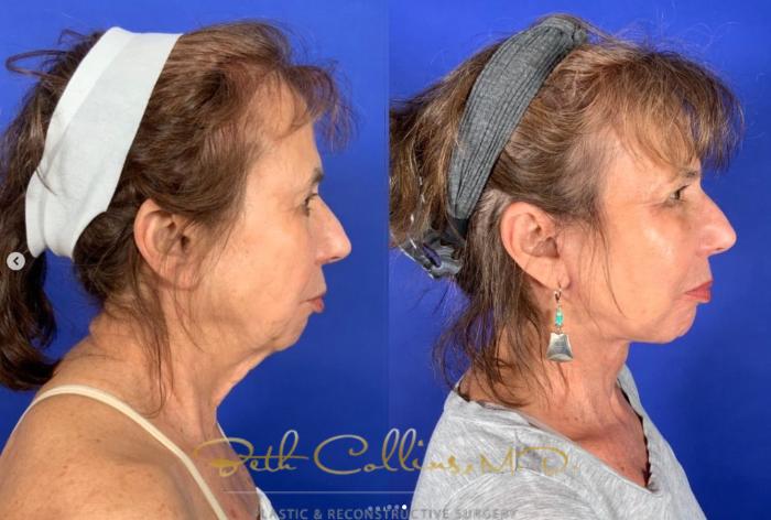 Before & After Facelift Case 266 Right Side View in Guilford, CT