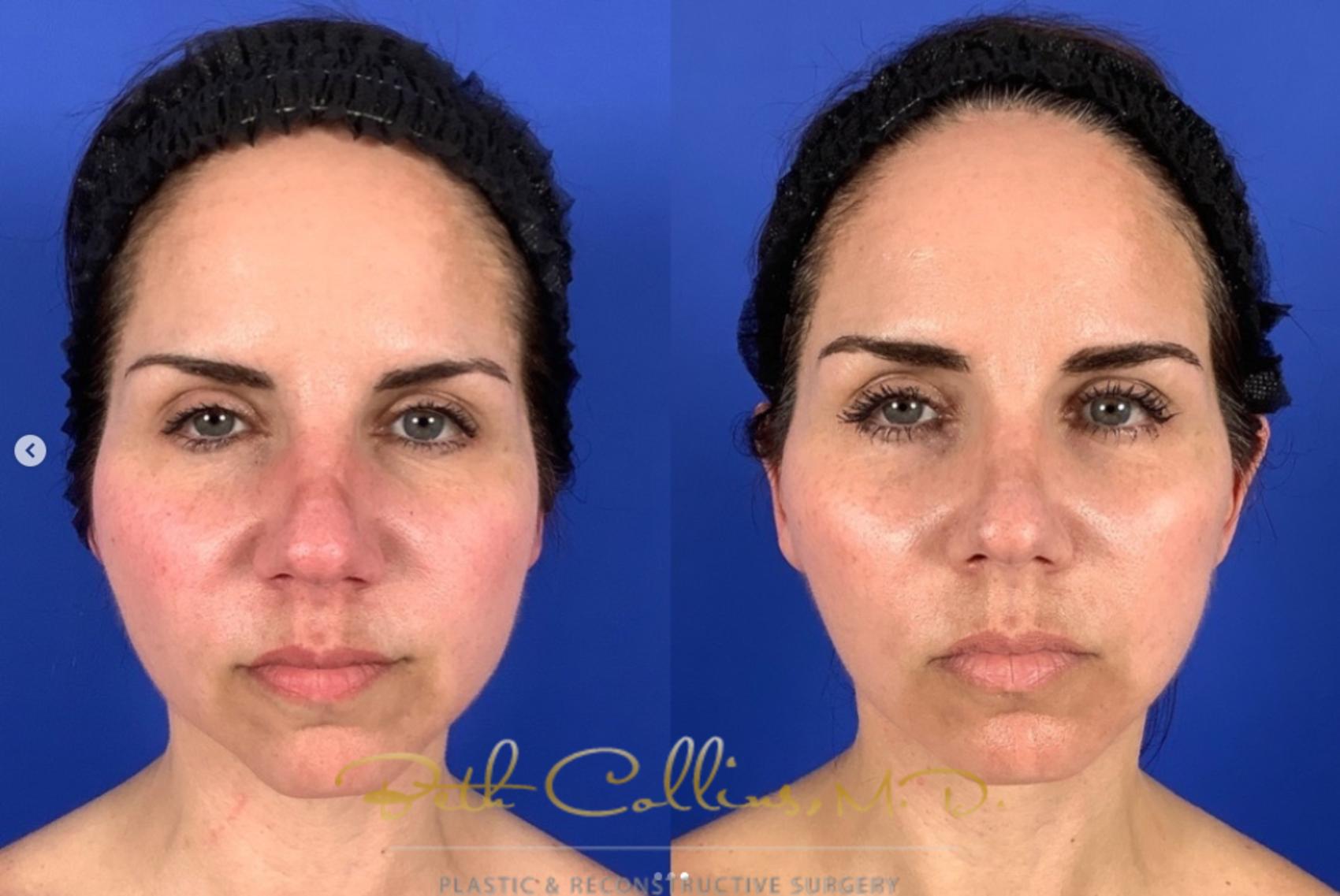 Before & After Facelift Case 268 Front View in Guilford, CT