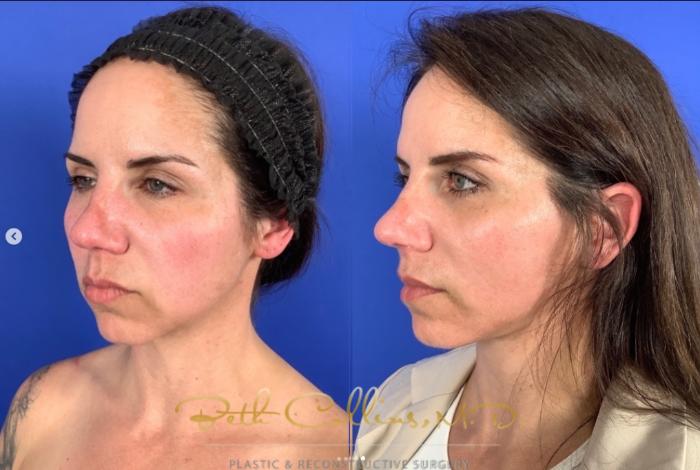 Before & After Facelift Case 268 Left Oblique View in Guilford, CT