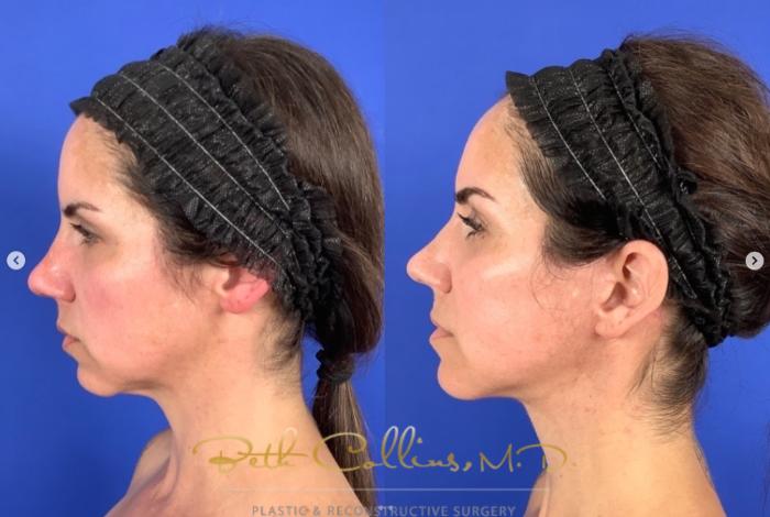 Before & After Facelift Case 268 Left Side View in Guilford, CT