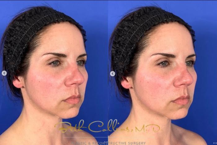 Before & After Facelift Case 268 Right Oblique View in Guilford, CT