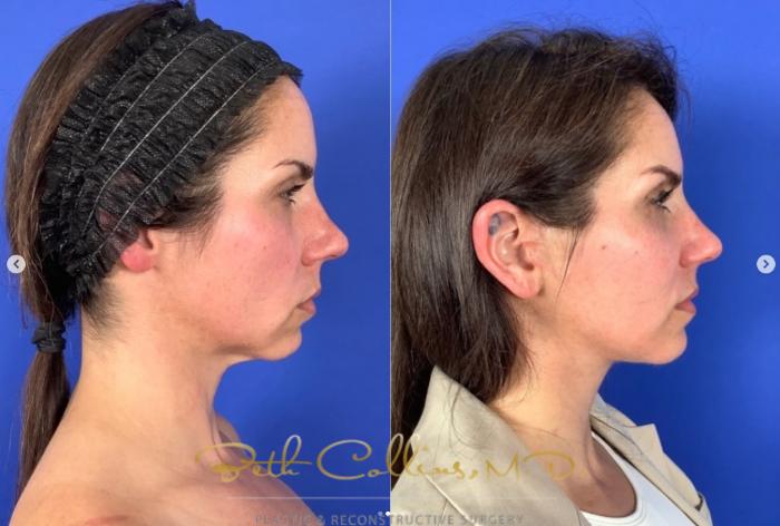 Before & After Facelift Case 268 Right Side View in Guilford, CT