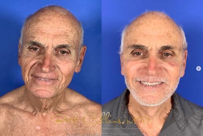 Before & After Facelift Case 269 Front - 10 Days After Surgery View in Guilford, CT