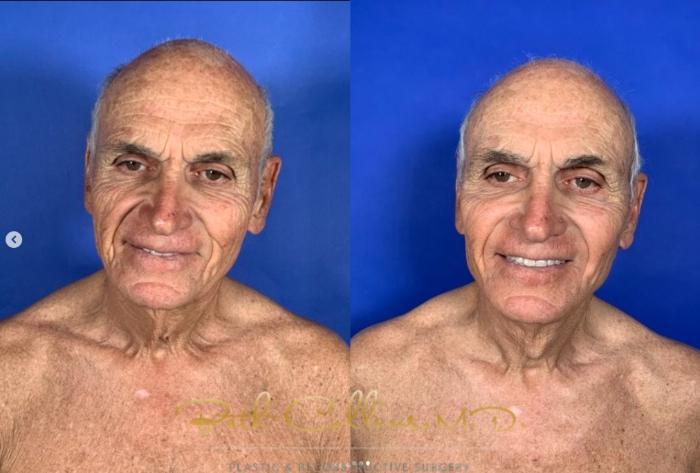 Before & After Facelift Case 269 Front View in Guilford, CT