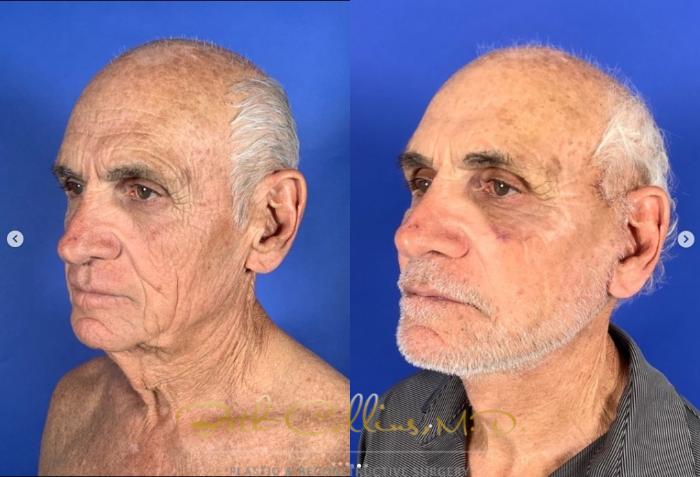 Before & After Neck Lift Case 269 Left Oblique - Front - 10 Days After Surgery View in Guilford, CT