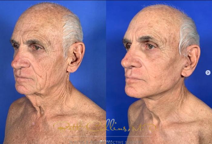 Before & After Facelift Case 269 Left Oblique View in Guilford, CT