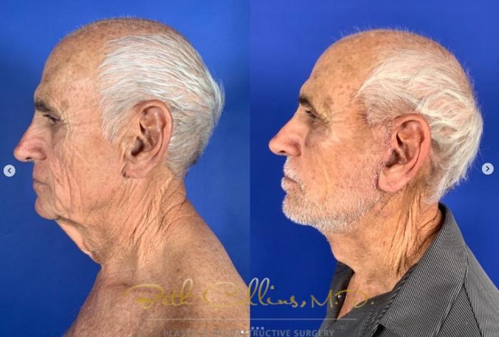 Before & After Neck Lift Case 269 Left Side - Front - 10 Days After Surgery View in Guilford, CT