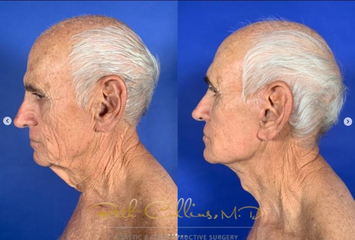 Before & After Neck Lift Case 269 Left Side View in Guilford, CT