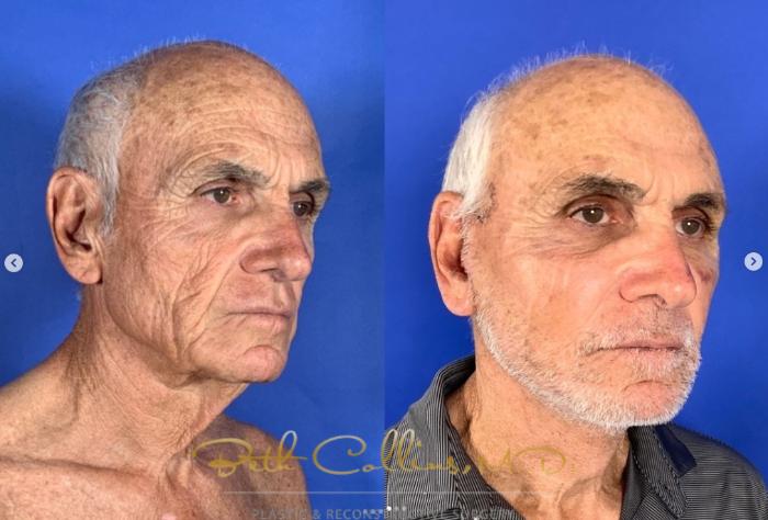 Before & After Facelift Case 269 Right Oblique - Front - 10 Days After Surgery View in Guilford, CT