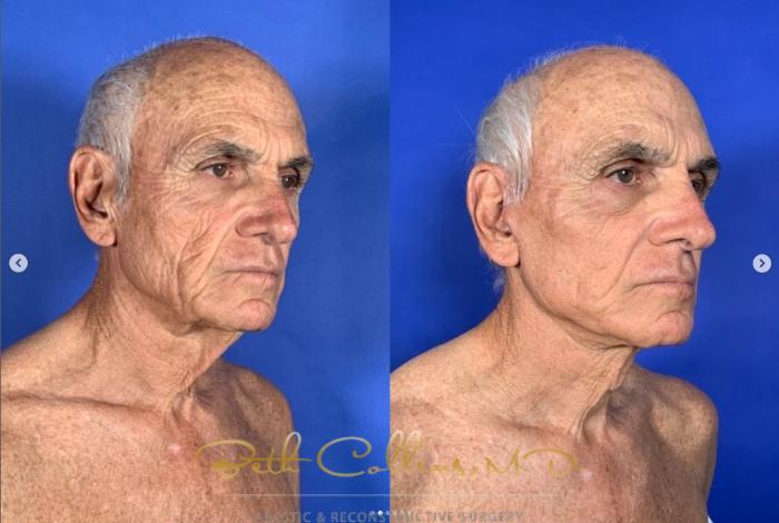 Before & After Neck Lift Case 269 Right Oblique View in Guilford, CT