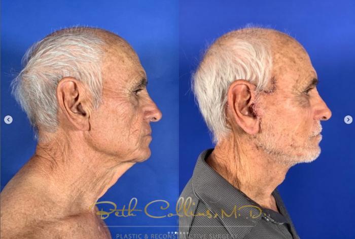 Before & After Facelift Case 269 Right Side - 10 Days After Surgery View in Guilford, CT