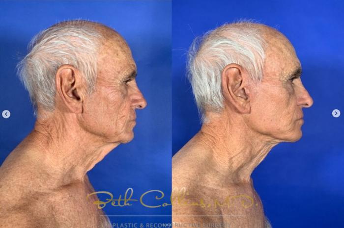 Before & After Neck Lift Case 269 Right Side View in Guilford, CT