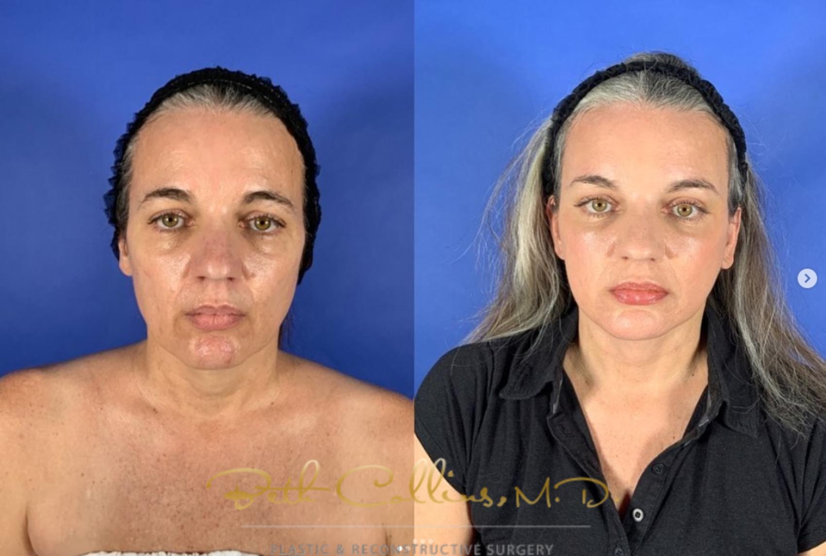 Before & After Neck Lift Case 271 Front View in Guilford, CT