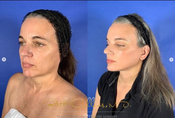 Before & After Facelift Case 271 Left Oblique View in Guilford, CT