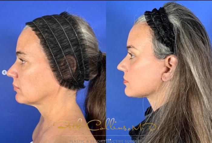 Before & After Neck Lift Case 271 Left Side View in Guilford, CT