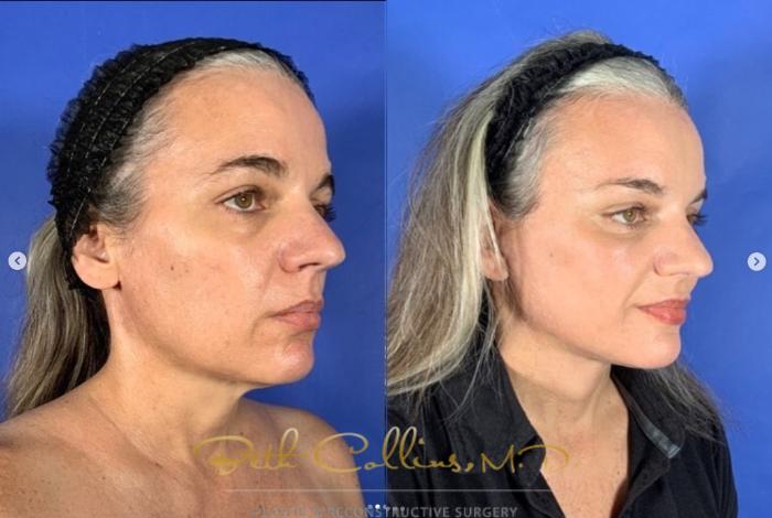 Before & After Facelift Case 271 Right Oblique View in Guilford, CT