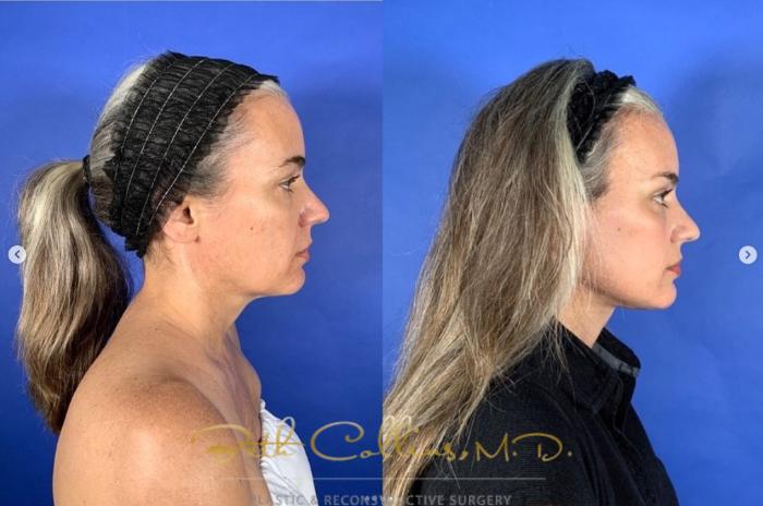 Before & After Facelift Case 271 Right Side View in Guilford, CT