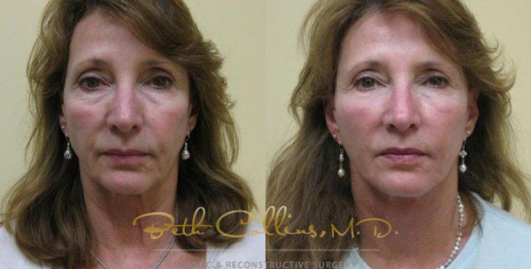 Facelift Case 73 Before & After View #1 | Guilford, CT | Beth Collins M.D.