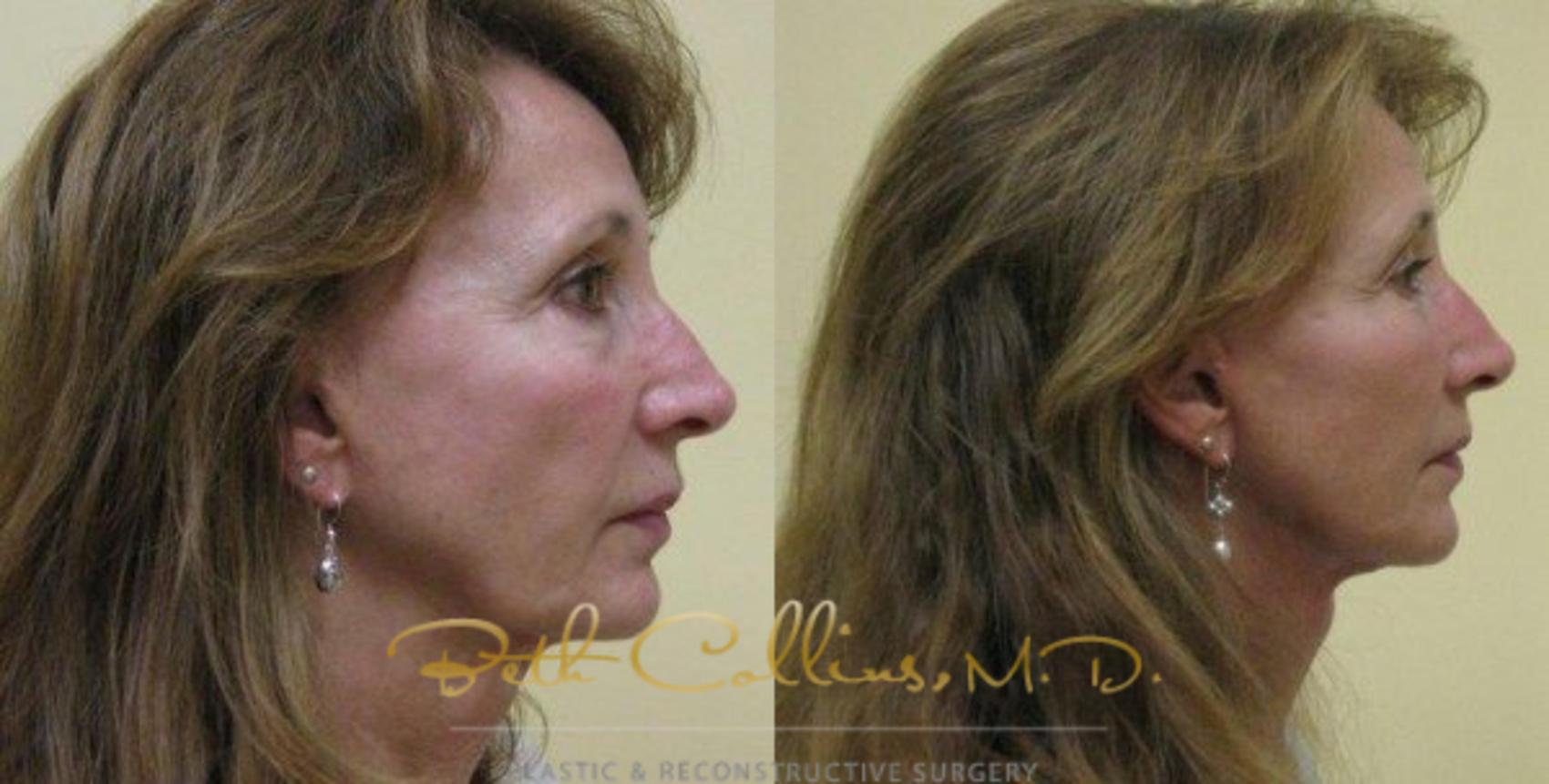 Facelift Case 73 Before & After View #2 | Guilford, CT | Beth Collins M.D.
