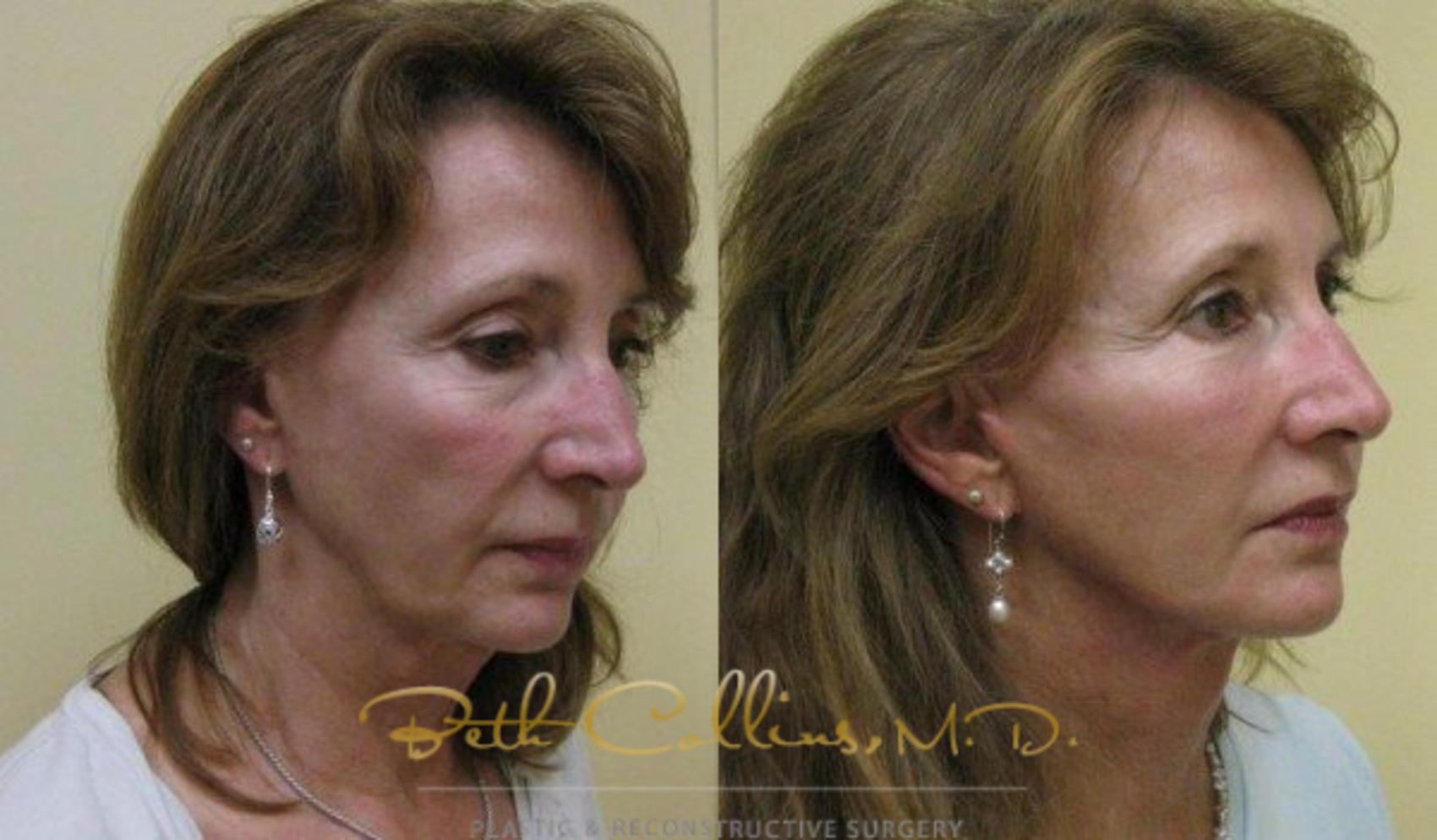 Facelift Case 73 Before & After View #3 | Guilford, CT | Beth Collins M.D.