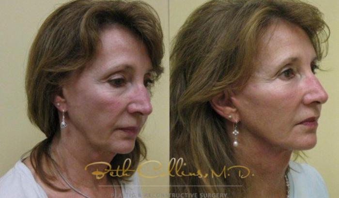 Before & After Facelift Case 73 View #3 View in Guilford, CT