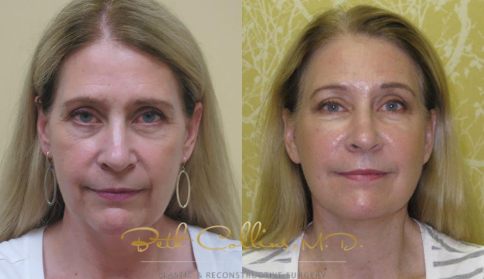 Facelift Case 76 Before & After View #1 | Guilford, CT | Beth Collins M.D.