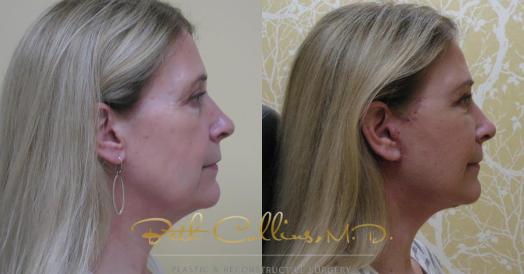 Facelift Case 76 Before & After View #2 | Guilford, CT | Beth Collins M.D.