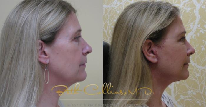 Before & After Facelift Case 76 View #2 View in Guilford, CT