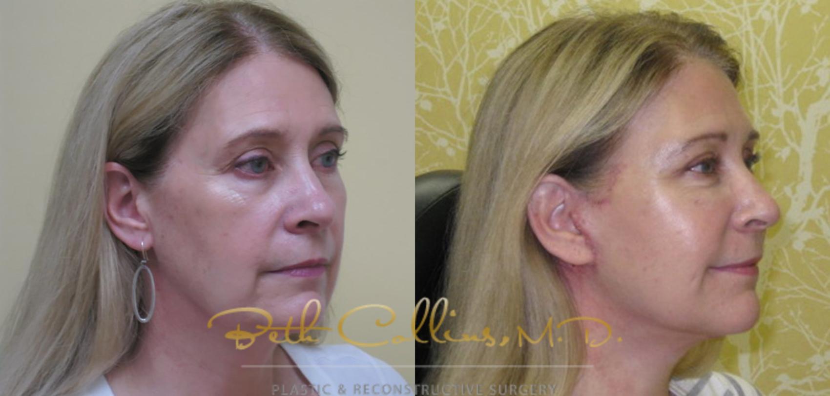 Facelift Case 76 Before & After View #3 | Guilford, CT | Beth Collins M.D.