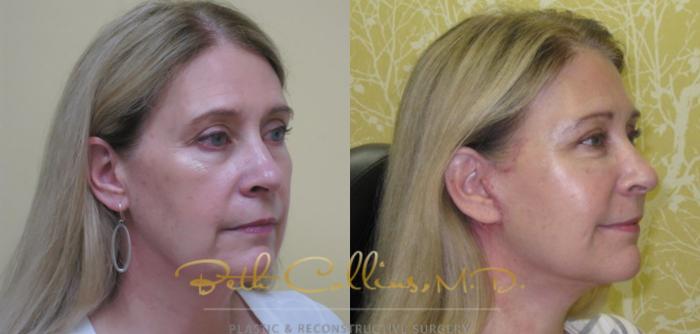 Before & After Facelift Case 76 View #3 View in Guilford, CT