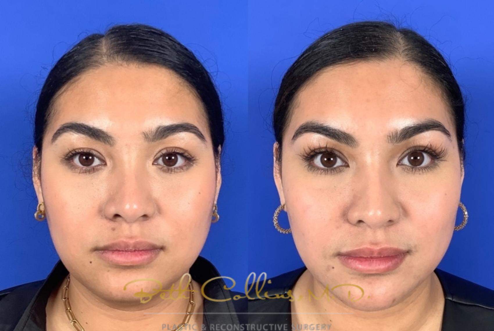 Before & After Facial Balancing Case 209 Front View in Guilford, CT