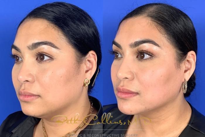 Before & After Facial Balancing Case 209 Left Oblique View in Guilford, CT