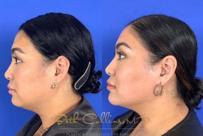 Before & After Facial Balancing Case 209 Left Side View in Guilford, CT