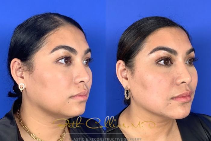 Before & After JUVÉDERM® Case 209 Right Oblique View in Guilford, CT