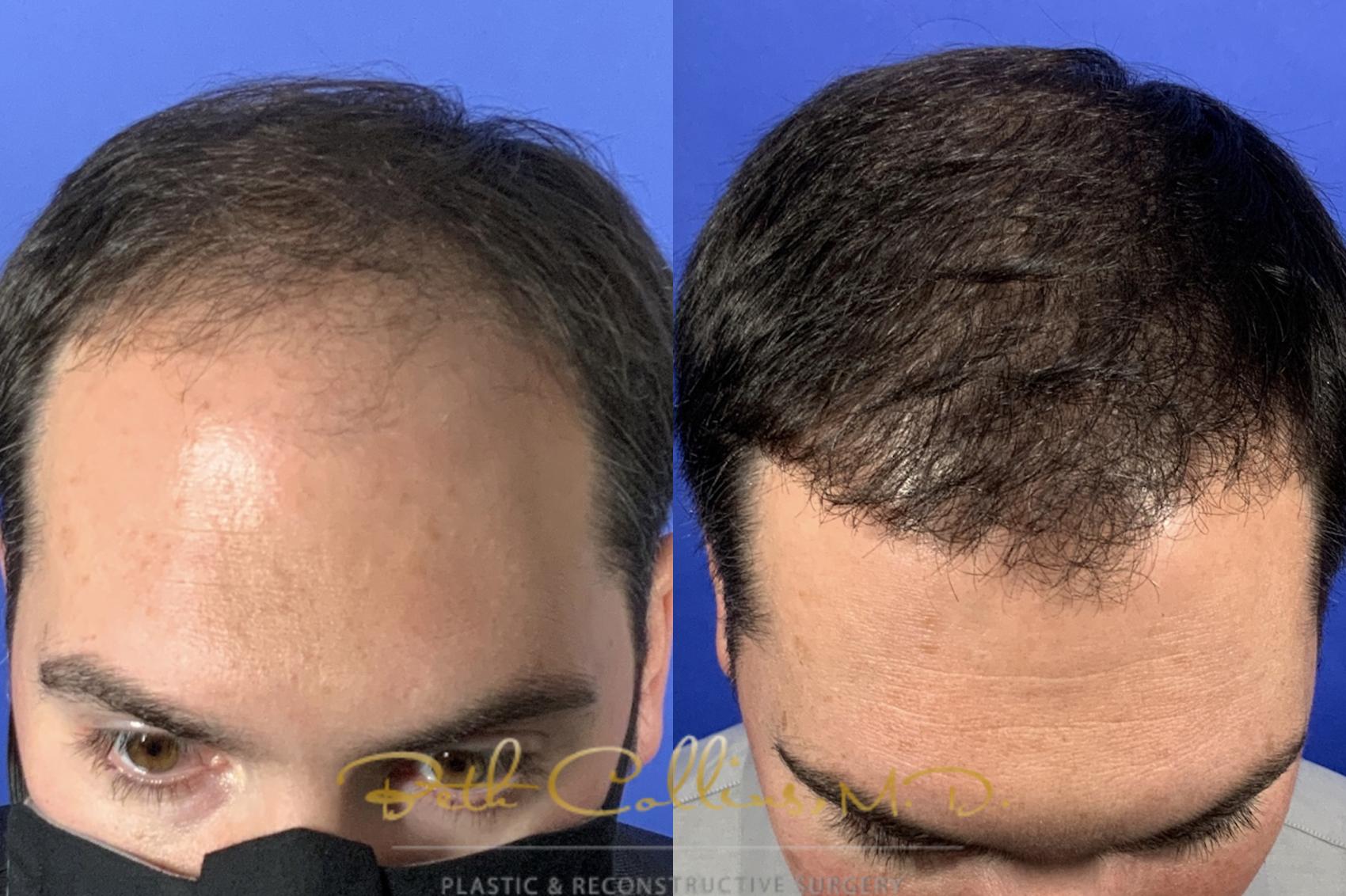 NeoGraft® Hair Restoration for Guilford, Mystic & New Haven, CT | Beth  Collins, .