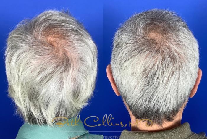 Before & After Hair Restoration Case 219 Back View in Guilford, CT