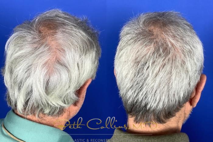 Before & After Hair Restoration Case 219 Right Oblique View in Guilford, CT
