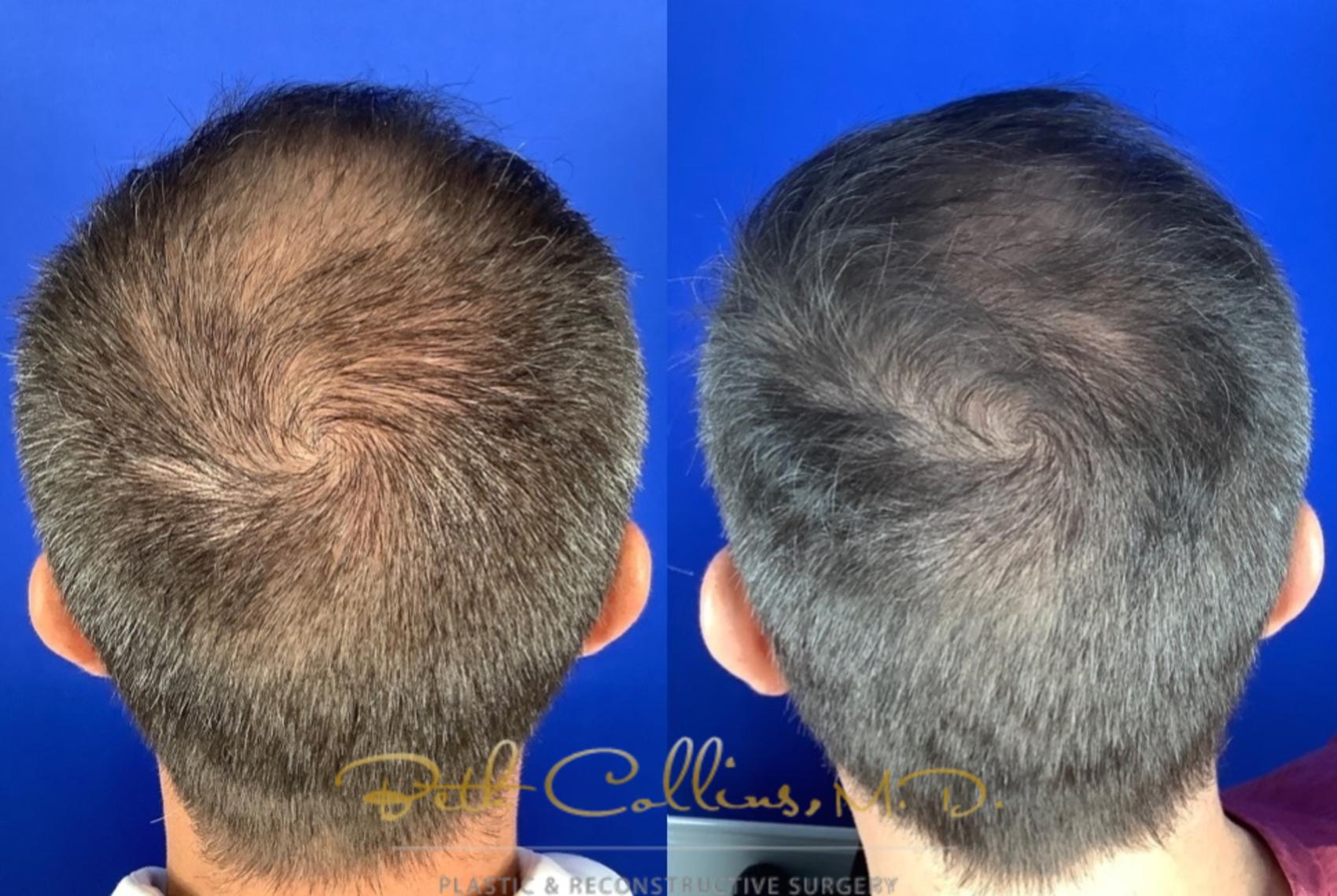 Before & After Hair Restoration Case 220 Back View in Guilford, CT