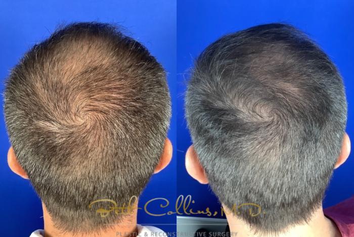 Before & After Hair Restoration Case 220 Back View in Guilford, CT